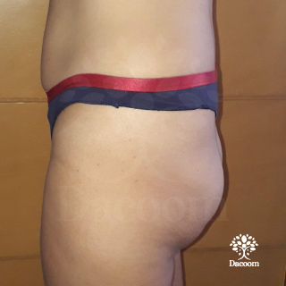 masajes reductivos maderoterapia cancun