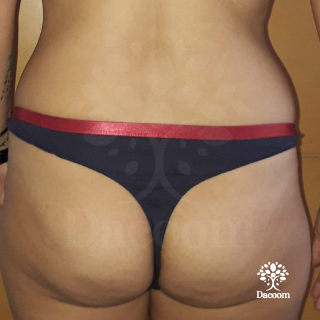 masajes reductivos maderoterapia cancun